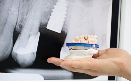 Zahnimplantate – funktionell und ästhetisch versorgt